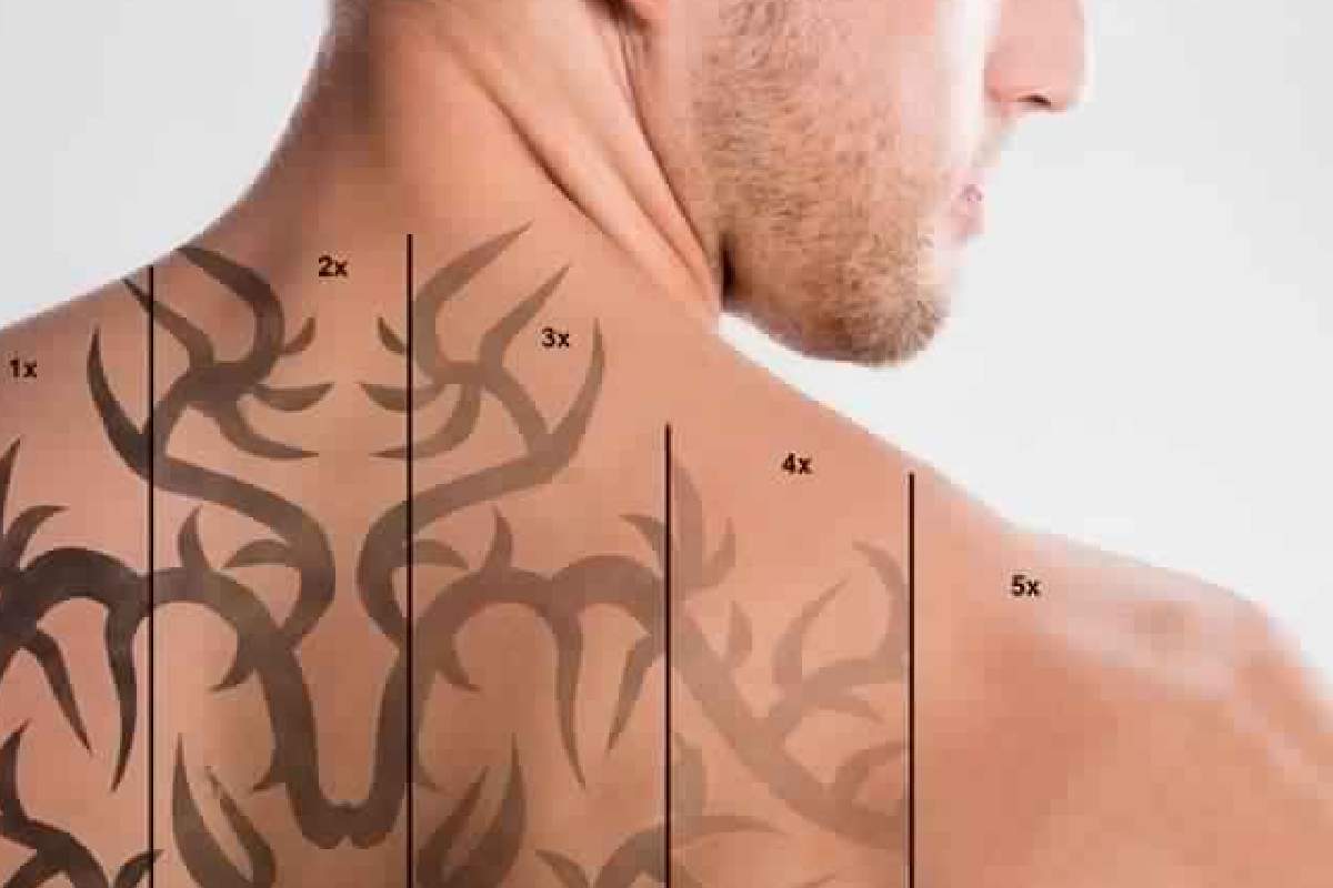 Tattoo Removal Healing Stages: What to Expect Week by Week