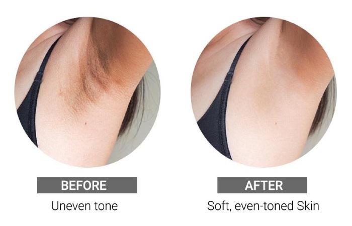 dermdoc underarm spray results timeline brightening