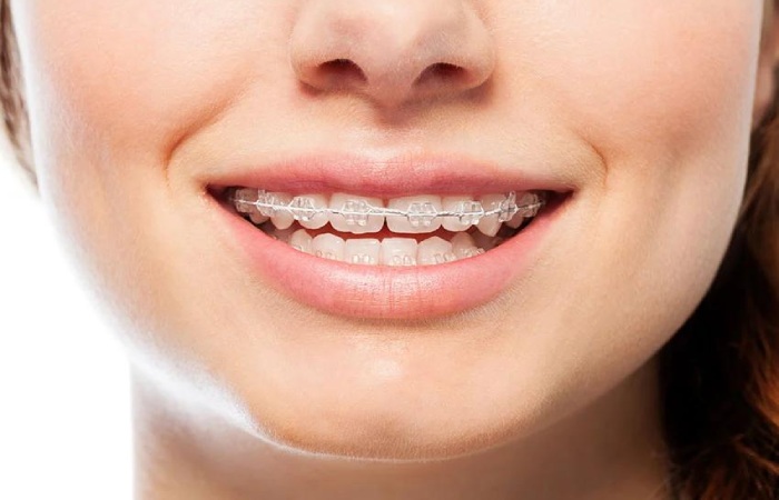 greenberg dental orthodontics clear ceramic braces teen