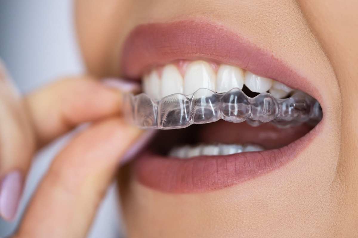 Your Smile Is Part of Your Identity, Why Alignment Is More Than Just Aesthetic